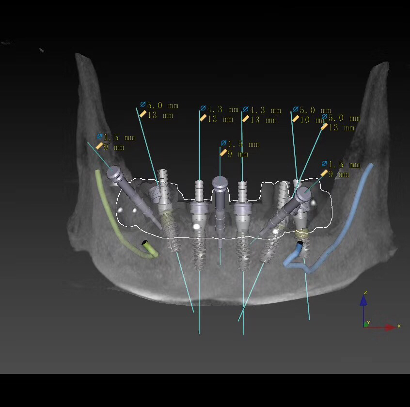 数字化种植牙:电脑软件术前3d分析虚拟设计全程导航精准植入种植即刻
