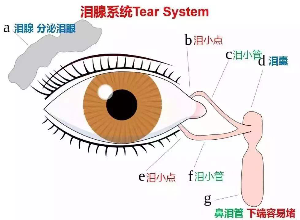 鼻泪管下段堵塞:致流泪,眼分泌物增多