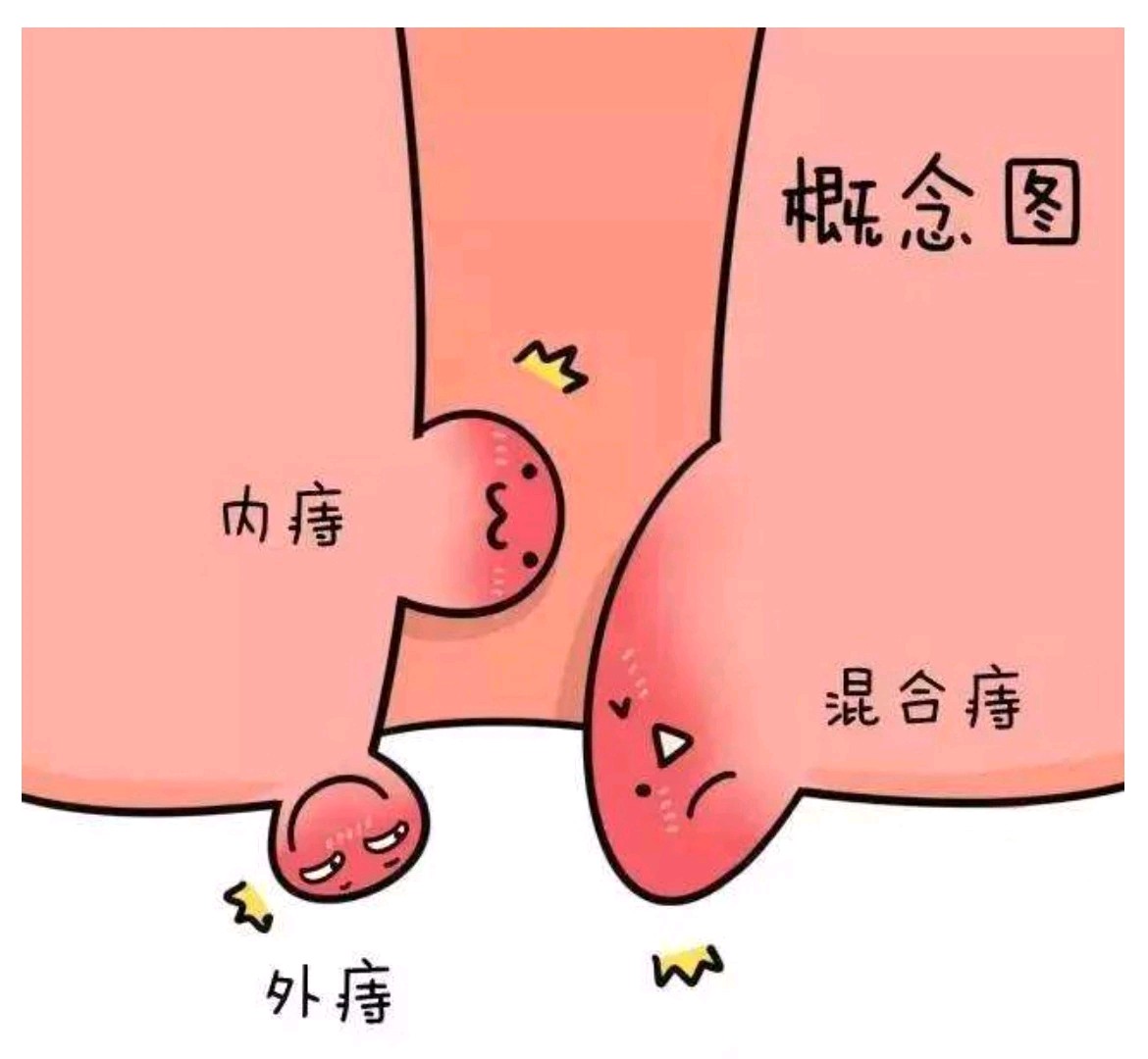 肛门肿物就是脱肛吗