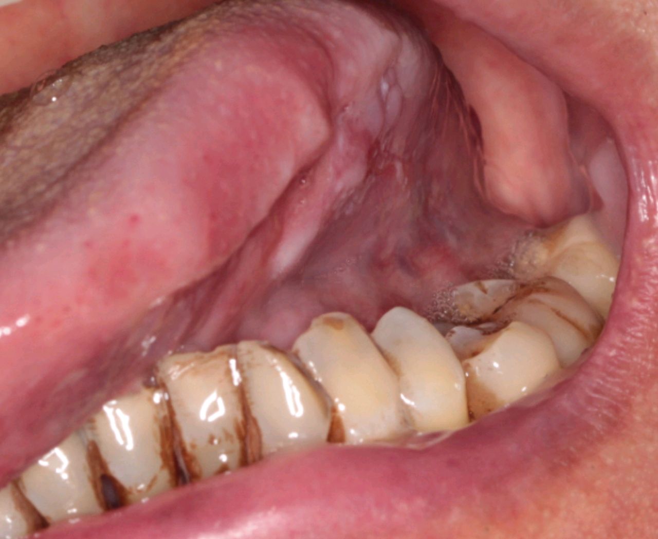 口腔癌是口腔颌面部最常见的恶性肿瘤,包括舌癌,牙龈癌,颊黏膜癌,腭
