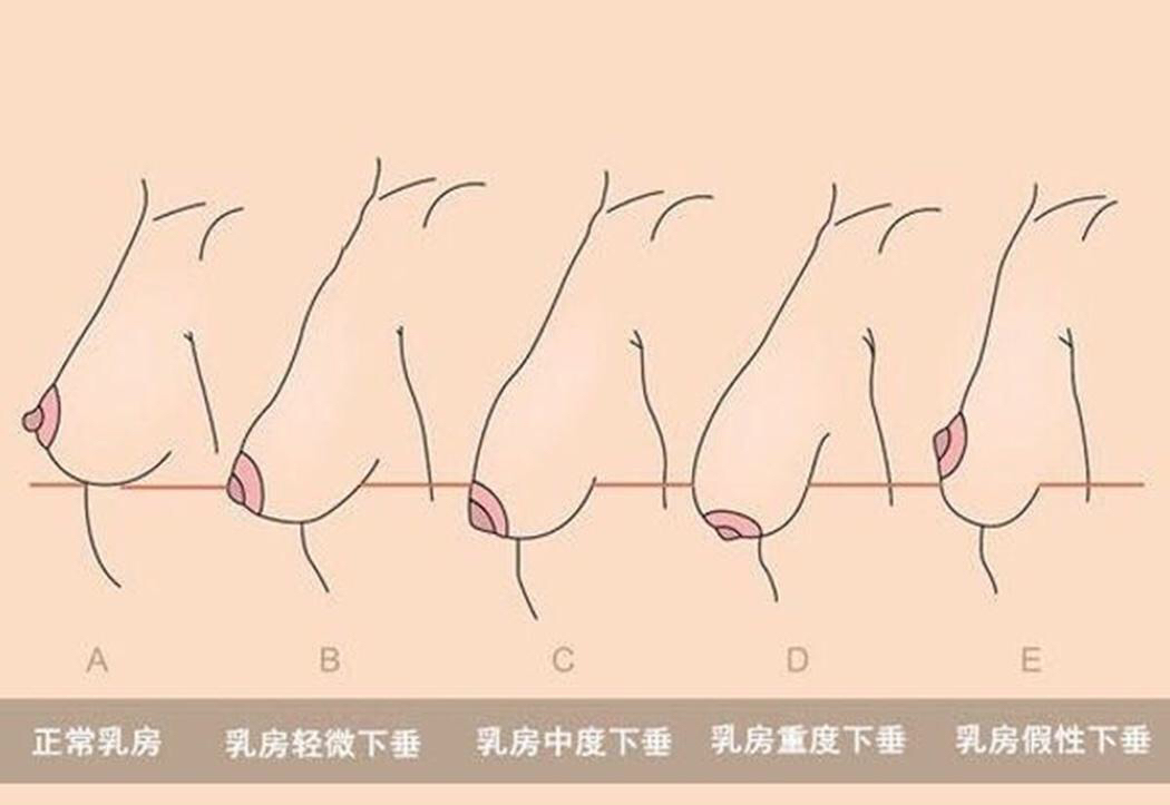 轻度下垂:胸部下垂的乳头与乳房下皱