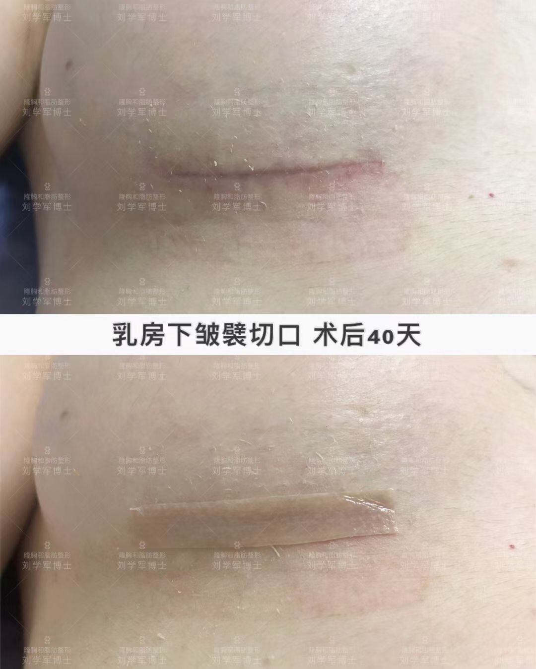假体隆胸新乳房下皱襞的重要性
