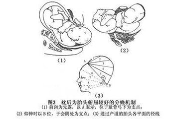 持续性枕后位难产