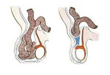 腹股沟滑动性疝
