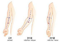 肘内翻畸形是什么-骨科常见疾病-就医160网上