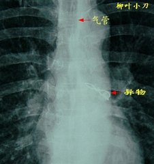 气管支气管异物