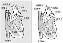 矫正型大动脉错位