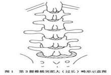 第3腰椎横突过长畸形