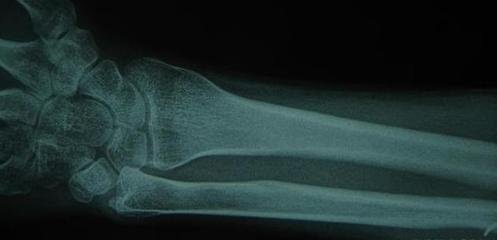 桡骨干骨折的原因-桡骨干骨折是怎么引起的-急诊科-.