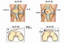 习惯性髌骨脱位_疾病库_疾病查询_疾病大全_就医160网_网上预约挂号统一平台