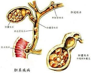 常见症状:  简介                胆石病是指胆道系统(包括