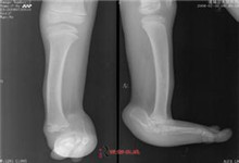 先天性腓骨缺如