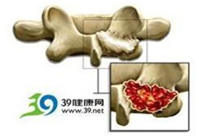 小儿动脉瘤样骨囊肿