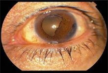 表现为角膜内皮异常,进行性虹膜基质萎缩,广泛的周边虹膜前粘连,房角