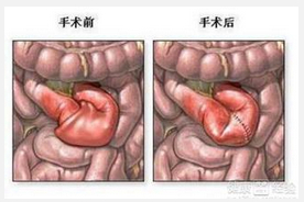 小儿蛔虫性肠梗阻