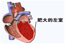 肥厚型心肌病