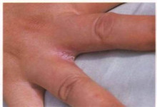 皮肤念珠菌病的症状-皮肤念珠菌病的早期症状-皮肤科