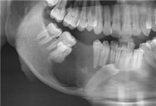 颌骨囊肿的并发症-颌骨囊肿会引起什么疾病-口腔科-.