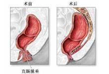 直肠脱垂_疾病库_疾病查询_疾病大全_就医160网_网上