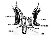 直肠阴道瘘