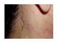 好发于头面部.皮损部丘疹长有毛发和排出皮脂样物是本病特征.