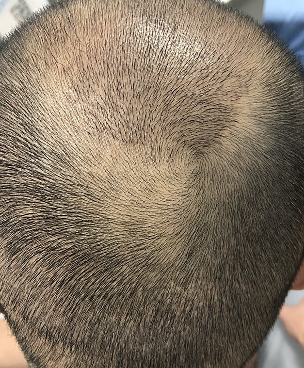 脂溢性脱发植发术后,枕后上方头皮未植发处毛发明显稀疏