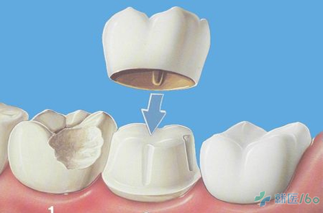 需要做牙齿修复,你知道哪种材料好吗?