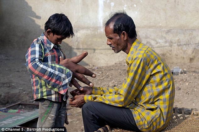 世界最大手:8岁印度男孩手指粗如小腿_健康资