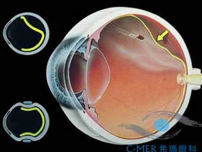 微创玻璃体切除术,治疗视网膜脱落