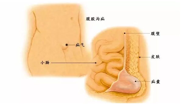 腹股沟斜疝从位于腹壁下动脉外侧的腹股沟管深环突出,向内下,向前