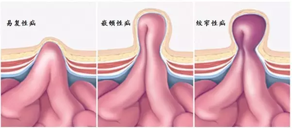 健康资讯 独家 推荐 了解这种常见病,或许能少些悲剧    2,滑动性疝