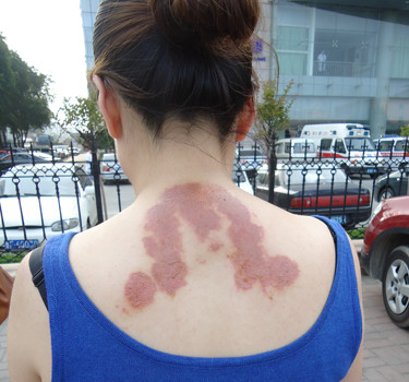 坑娃的三伏贴,为何父母还是乐此不彼