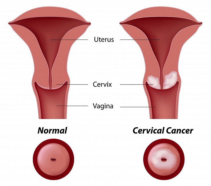 宫颈癌疫苗"超龄"男女也能接种 安全套防不了hpv_健康160