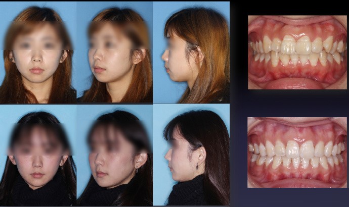 这些活生生的案例都说明了牙齿矫正不但可以改善脸形,而且针对东方