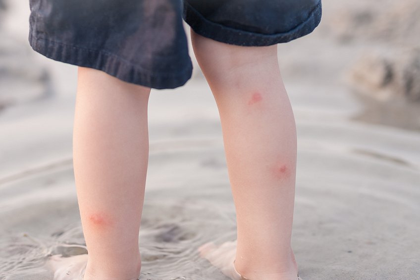炎炎夏日,蚊子也多了起来,有的父母为了防止宝宝被蚊虫叮咬,都习惯