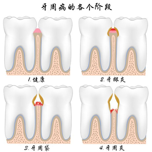 早上刷牙总出血小心牙周炎