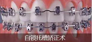 牙齿矫正的种类介绍自锁正畸托槽矫治过程舒适高效,卫生