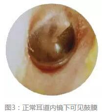 预防措施1,每年体检的时候,如果看到体检报告上写着"耵聍栓塞,建议