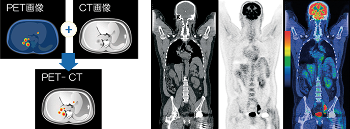 PET-CT