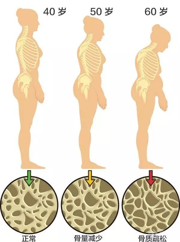 骨质疏松静悄悄来临的疾病