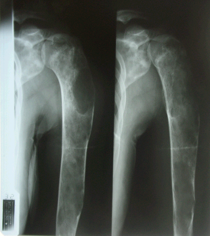 【骨肿瘤医学科普】纤维异样增殖症(fibrous dysplasia)