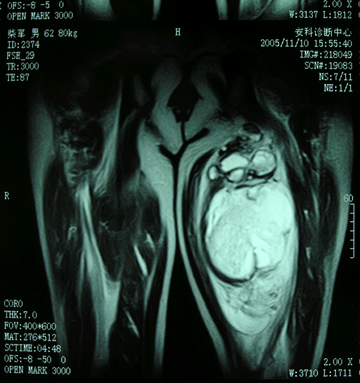 骨肿瘤医学科普恶性纤维组织细胞瘤malignantfibroushistiocytomamfh