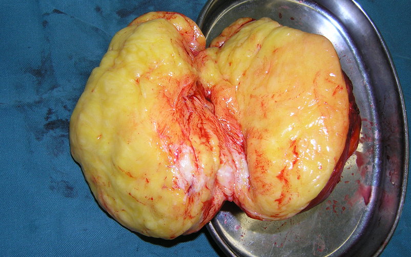 肿瘤剖面组织学特点:增生成熟的脂肪组织中见纤维组织.