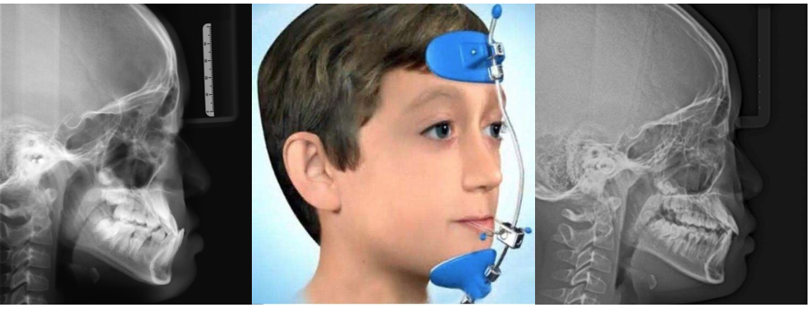 如地包天,小下巴等,需要在8-10岁,通过矫正治疗改良上下颌骨的发育