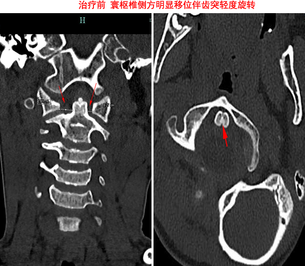 "——数据漫谈"寰枢椎半脱位