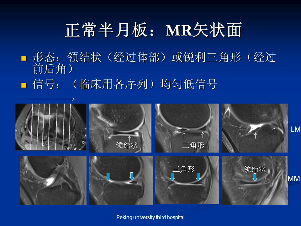 [膝knee-半月板] 核磁(mri)报告说半月板损伤就是真的