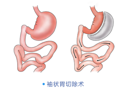 胃转流手术与袖状胃切除术哪个效果比较好