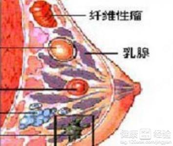 发现乳腺纤维腺瘤怎么办