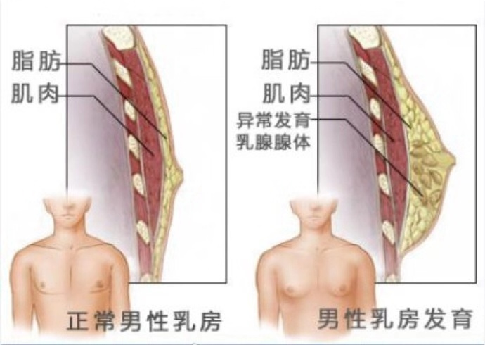 "南乳"知多少---浅谈男性乳腺发育