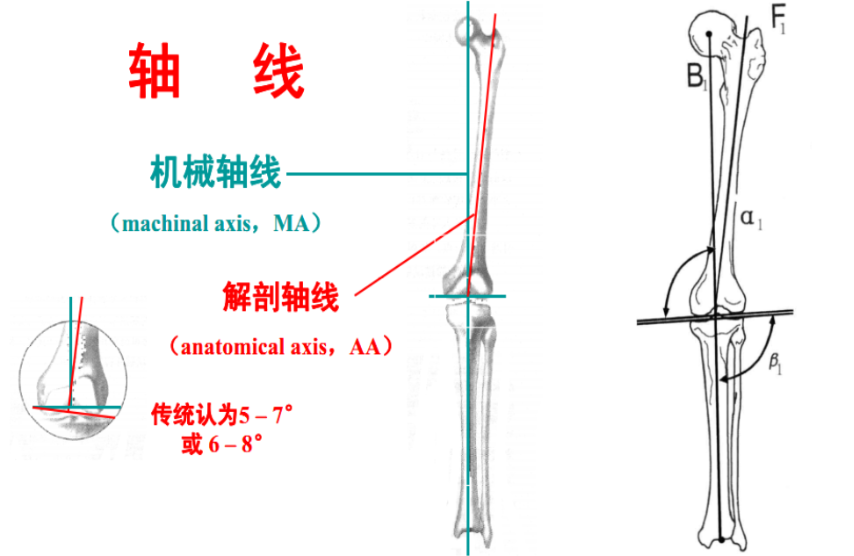 三,膝关节炎与异常下肢力线